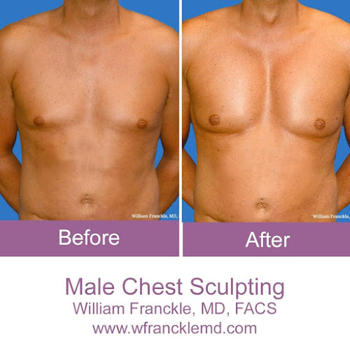 William Franckle, MD, FACS